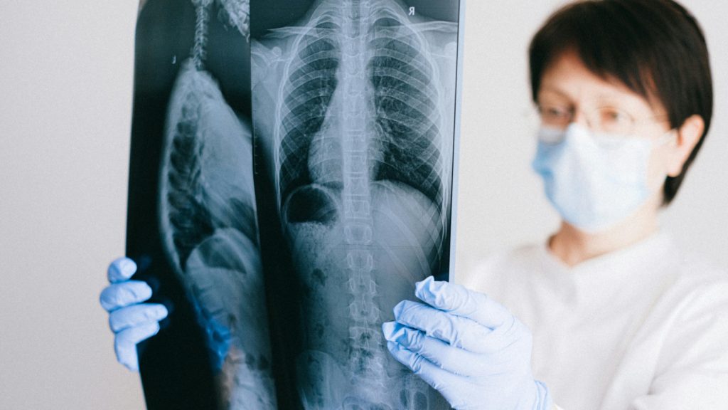 Prevencija i rana dijagnostika ključni u borbi protiv raka pluća